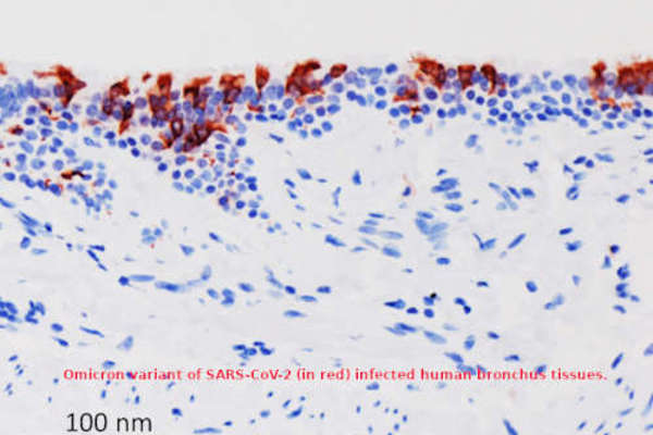 La Omicron trasforma Covid-19 da polmonite a bronchite